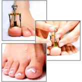 ابزار ارتودنسی و اصلاح ناخن فرو رفته