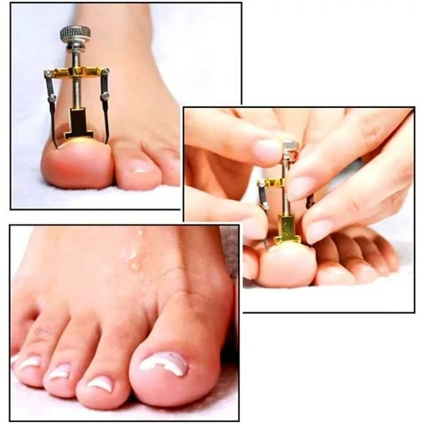 ابزار ارتودنسی و اصلاح ناخن فرو رفته