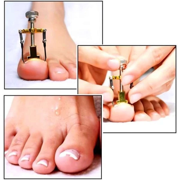 ابزار اصلاح و ارتودنسی ناخن